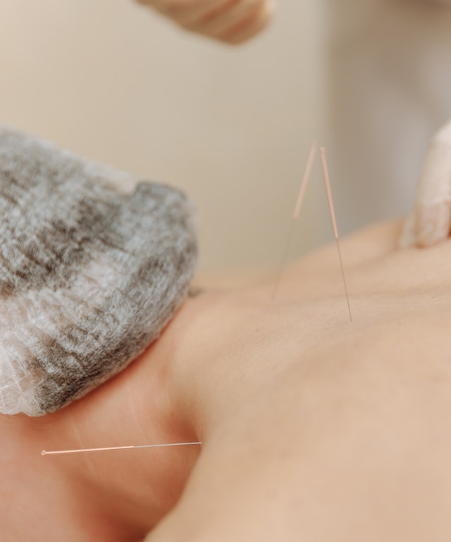 Acupuncture Pain Reliefe