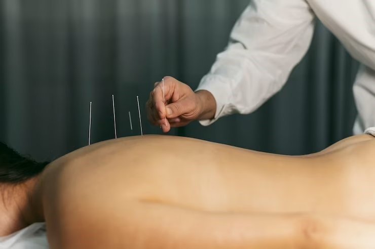Cupping & Acupuncture Therapy